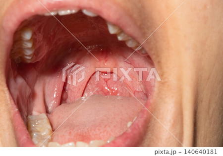 Sore throat with throat swollen. Closeup open mouth with posterior pharyngeal wall swelling and uvula and tonsil. Influenza follicles in the posterior pharyngeal wall. Upper respiratory tract. 140640181