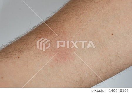 Close-up of a red allergic rash and skin irritation on a patient hand Close-up of a red allergic rash and skin irritation on a patient hand 140648193
