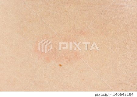 Detailed macro shot of dermatitis spots and redness on sensitive skin Detailed macro shot of dermatitis spots and redness on sensitive skin 140648194