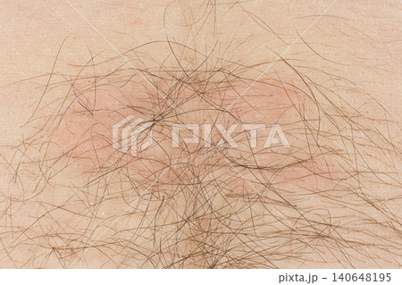 Contact dermatitis symptoms showing red inflamed bumps on human skin 140648195