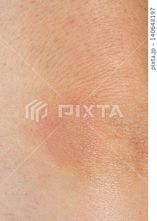 Close-up of a red allergic rash and skin irritation on a human skin Close-up of a red allergic rash and skin irritation on a human skin 140648197