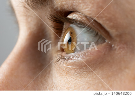 Conical cornea deformity in severe keratoconus patient 140648200