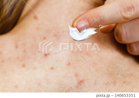 Woman with pimple on back applying medical ointmeny 140653351