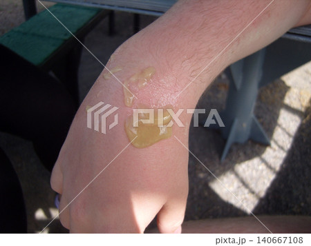 Close-up of a thick, yellowish gel ointment being applied to treat a red, burned, or injured area of skin on a person's hand and wrist outdoors. Close-up of a thick, yellowish gel ointment being applied to treat a red, burned, or injured area of skin on a person's hand and wrist outdoors. 140667108