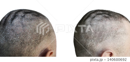 Scalp comparison with dandruff and clean skin on short hair, Scalp comparison with dandruff and clean skin on short hair, 140680692