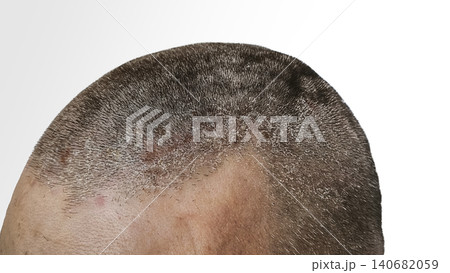 Scalp with dandruff and visible white flakes on short hair, 140682059