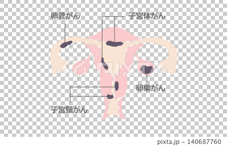 婦科癌症圖解(女性生殖器官解剖圖) 婦科癌症圖解(女性生殖器官解剖圖) 140687760