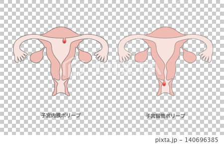子宮頸息肉和子宮內膜息肉示意圖 子宮頸息肉和子宮內膜息肉示意圖 140696385