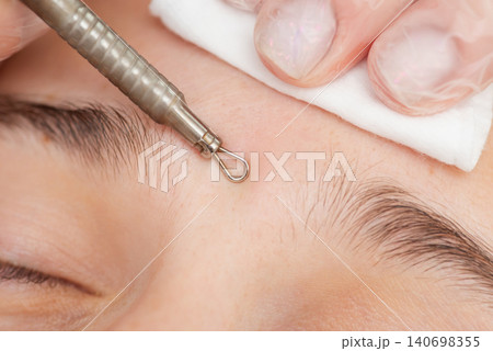 Procedure for cleaning the skin of female from blackheads and acne, close up. Cosmetologist making cleansing therapy with steel tool, blackhead remover, in the beauty salon Procedure for cleaning the skin of female from blackheads and acne, close up. Cosmetologist making cleansing therapy with steel tool, blackhead remover, in the beauty salon 140698355