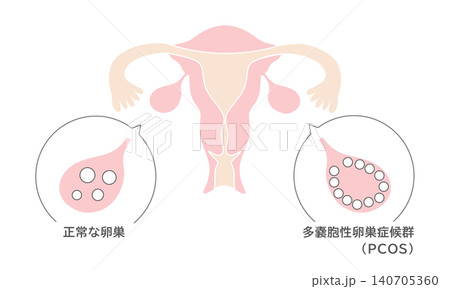 正常な卵巣と多嚢胞性卵巣症候群(PCOS)の図解イラスト 正常な卵巣と多嚢胞性卵巣症候群(PCOS)の図解イラスト 140705360