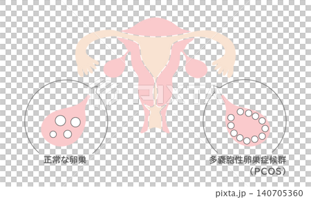 正常な卵巣と多嚢胞性卵巣症候群(PCOS)の図解イラスト 正常な卵巣と多嚢胞性卵巣症候群(PCOS)の図解イラスト 140705360