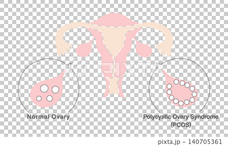 gynecology, PCOS, follicles 140705361