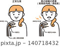 肩の組織の癒着 140718432