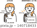 肩関節周囲炎 140718433
