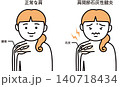 肩関節石灰性腱炎 140718434