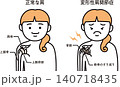 変形肩関節症 140718435