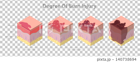3D Isometric Flat Illustration of Skin Burn Degree, Stages In Epidermis And Dermis Layers 3D Isometric Flat Illustration of Skin Burn Degree, Stages In Epidermis And Dermis Layers 140738694