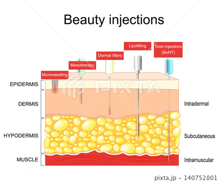Beauty injections for Mesotherapy, Dermal fillers, Lipofilling, Toxin injections BoNT, Microneedling. Cosmetic procedure. 140752801