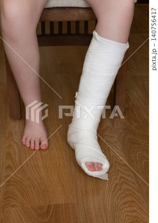Medical recovery series of a teenager resting with a broken leg in a plaster cast at home 140756417