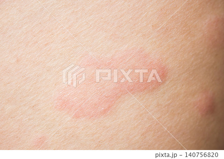 Skin allergy rash dermatitis texture close up background Skin allergy rash dermatitis texture close up background 140756820