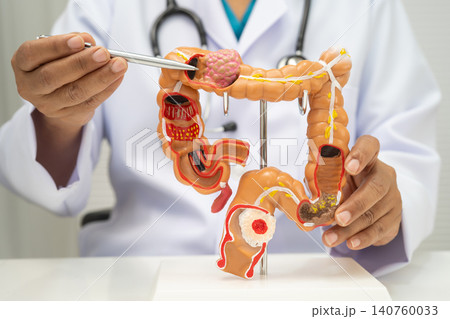Colorectal cancer, doctor holding intestine colon human anatomy model. Colorectal cancer, doctor holding intestine colon human anatomy model. 140760033