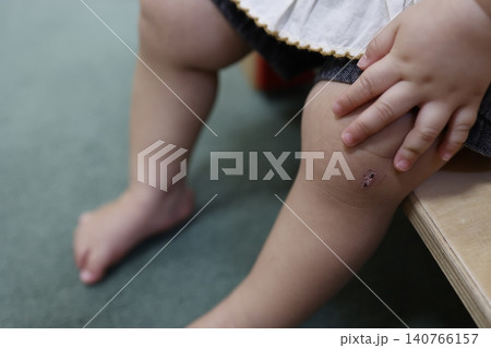 幼児の膝のかさぶた。子どもの怪我の治癒過程。クローズアップ 幼児の膝のかさぶた。子どもの怪我の治癒過程。クローズアップ 140766157