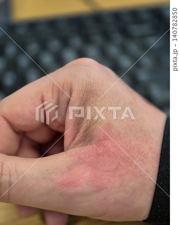 Close Up of Red Irritated Hand Skin Close Up of Red Irritated Hand Skin 140782850