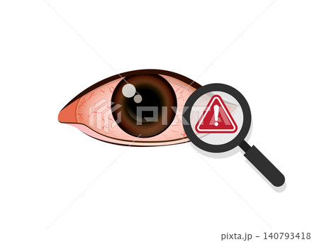Eye Redness and Irritation Medical Warning Illustration 140793418