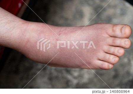Swollen Foot After Cast Removal of Metatarsal Fracture Swollen Foot After Cast Removal of Metatarsal Fracture 140808964