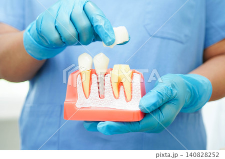 Doctor hold dental implant, artificial tooth roots into jaw, root canal of dental treatment, gum disease, teeth model for dentist studying about dentistry. Doctor hold dental implant, artificial tooth roots into jaw, root canal of dental treatment, gum disease, teeth model for dentist studying about dentistry. 140828252