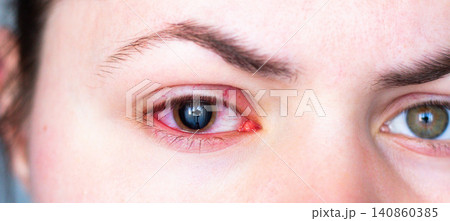 Woman showing red eye and enlarged pupil after ophthalmologist visit. Medical prescription for conjunctivitis treatment. Medical eye test in clinic Woman showing red eye and enlarged pupil after ophthalmologist visit. Medical prescription for conjunctivitis treatment. Medical eye test in clinic 140860385