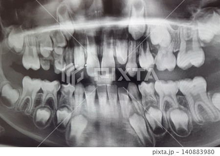 X-RAY PICTURE OF DAIRY AND NEW CHILDRENS TEETH. X-RAY PICTURE OF DAIRY AND NEW CHILDRENS TEETH. 140883980