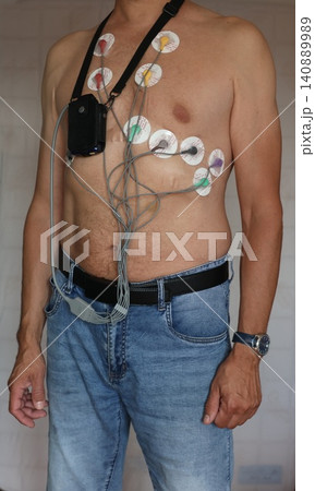 Close-up of an adult man wearing a portable Holter ECG monitor with multiple adhesive electrodes attached to the chest. Close-up of an adult man wearing a portable Holter ECG monitor with multiple adhesive electrodes attached to the chest. 140889989