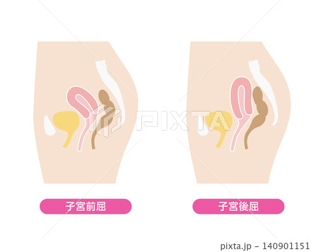 子宮前屈と子宮後屈のイラストセット 子宮前屈と子宮後屈のイラストセット 140901151