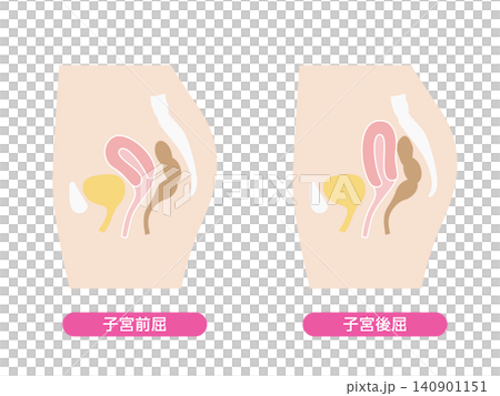子宮前屈と子宮後屈のイラストセット 子宮前屈と子宮後屈のイラストセット 140901151