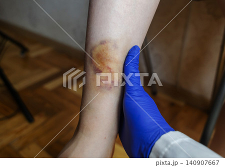 Doctor in blue gloves treating a large bruise and hematoma on a child leg. Medical care, first aid and treatment for pediatric skin injury or contusion. 140907667