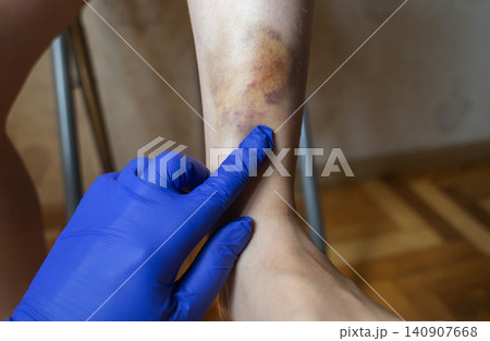 Doctor in blue gloves treating a large bruise and hematoma on a child leg. Medical care, first aid and treatment for pediatric skin injury or contusion. Doctor in blue gloves treating a large bruise and hematoma on a child leg. Medical care, first aid and treatment for pediatric skin injury or contusion. 140907668