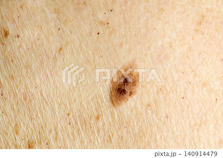 Human skin showing nevus, moles, and sun damage Human skin showing nevus, moles, and sun damage 140914479