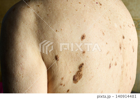Skin with numerous moles, freckles, and age spots Skin with numerous moles, freckles, and age spots 140914481