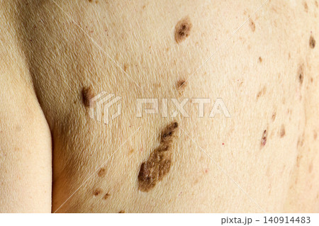 Human skin showing multiple moles and nevus Human skin showing multiple moles and nevus 140914483