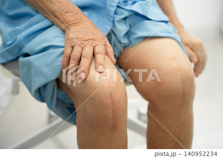 Asian elderly woman patient show her scars surgical total knee joint replacement Suture wound surgery arthroplasty on bed in hospital. Asian elderly woman patient show her scars surgical total knee joint replacement Suture wound surgery arthroplasty on bed in hospital. 140952234