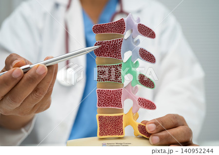 Doctor holding osteoporosis in back bone model. Doctor holding osteoporosis in back bone model. 140952244