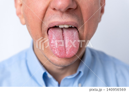 Man showing his tongue with a thick white coating and visible fissure, signifying potential health issues and the importance of checking oral hygiene for diagnosis 140956569