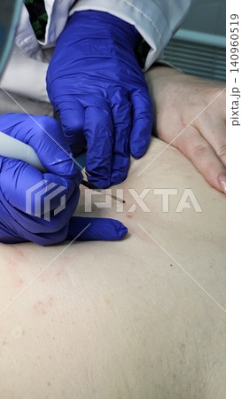 Post procedure skin treatment with antiseptic swab after papilloma and mole removal Post procedure skin treatment with antiseptic swab after papilloma and mole removal 140960519
