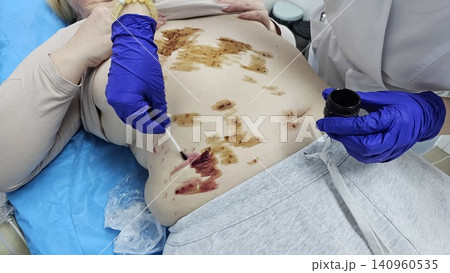 Professional removal of papillomas and moles with electrocoagulation procedure in dermatology clinic. overweight European woman on the surgical table. moles papillomas neoplasms on the body 140960535