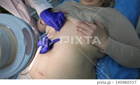 Professional removal of papillomas and moles with electrocoagulation procedure in dermatology clinic. overweight European woman on the surgical table. moles papillomas neoplasms on the body Professional removal of papillomas and moles with electrocoagulation procedure in dermatology clinic. overweight European woman on the surgical table. moles papillomas neoplasms on the body 140960557