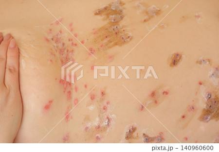 Applying healing cream after papilloma wart and mole removal during skin recovery care 140960600