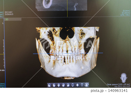 Dental cone beam computed tomography or CBCT diagnostic scan software displaying multi-planar views and a 3D maxillofacial reconstruction model. Healthcare Dental cone beam computed tomography or CBCT diagnostic scan software displaying multi-planar views and a 3D maxillofacial reconstruction model. Healthcare 140963141