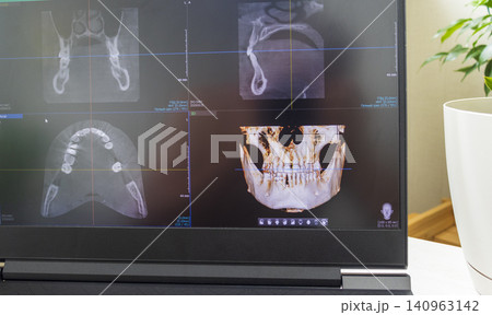 Dental cone beam computed tomography or CBCT diagnostic scan software displaying multi-planar views and a 3D maxillofacial reconstruction model. Healthcare Dental cone beam computed tomography or CBCT diagnostic scan software displaying multi-planar views and a 3D maxillofacial reconstruction model. Healthcare 140963142