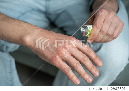 Man applying medical moisturizing gel for treatment of dry damaged areas on skin to heal cracks. Man applying medical moisturizing gel for treatment of dry damaged areas on skin to heal cracks. 140987791